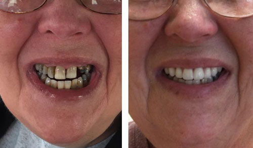 Complete & partial dentures